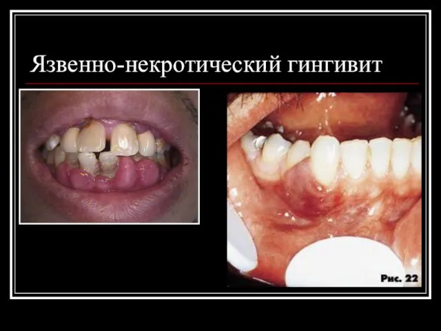 Язвенно-некротический гингивит