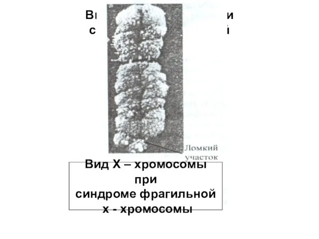 Вид Х – хромосомы при синдроме фрагильной х - хромосомы