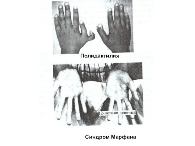 Полидактилия Полидактилия Синдром Марфана