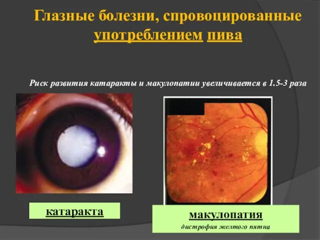Глазные болезни, спровоцированные употреблением пива Риск развития катаракты и макулопатии увеличивается в 1.5-3