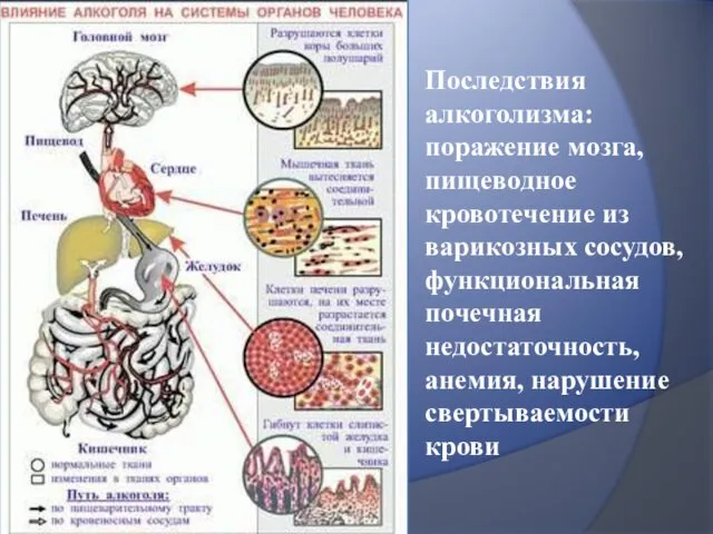 Последствия алкоголизма: поражение мозга, пищеводное кровотечение из варикозных сосудов, функциональная почечная недостаточность, анемия, нарушение свертываемости крови