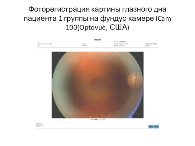 Фоторегистрация картины глазного дна пациента 1 группы на фундус-камере iCam 100(Optovue, США)