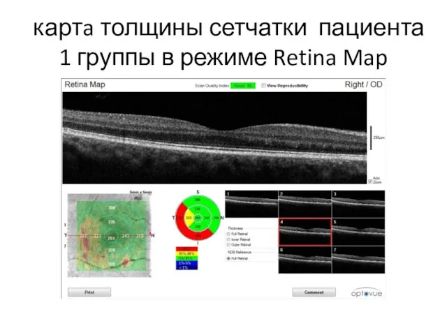 картa толщины сетчатки пациента 1 группы в режиме Retina Map