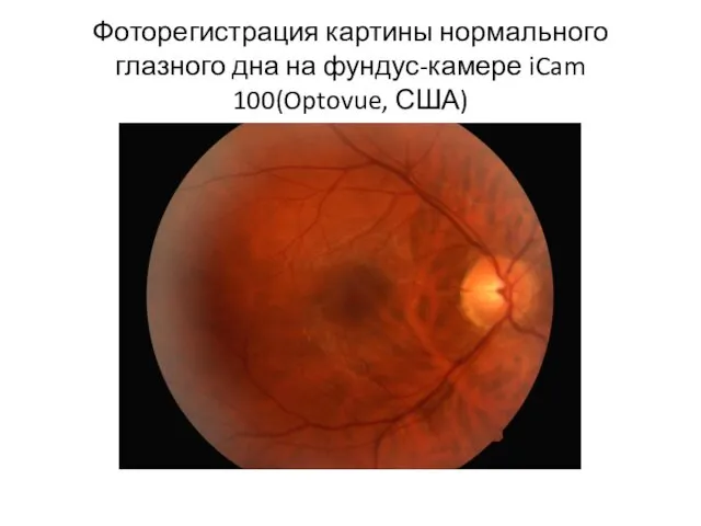 Фоторегистрация картины нормального глазного дна на фундус-камере iCam 100(Optovue, США)