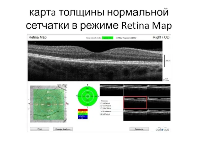 картa толщины нормальной сетчатки в режиме Retina Map