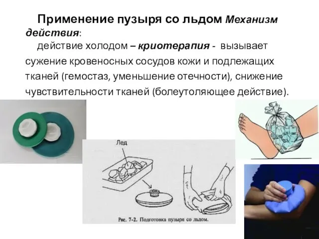 Применение пузыря со льдом Механизм действия: действие холодом – криотерапия - вызывает сужение