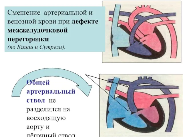 Cмешение артериальной и венозной крови при дефекте межжелудочковой перегородки (по