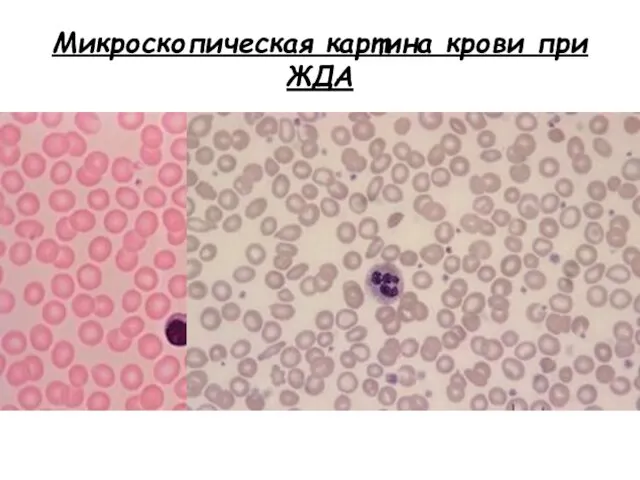 Микроскопическая картина крови при ЖДА