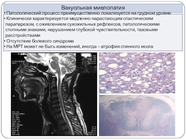 Вакуольная миелопатия Патологический процесс преимущественно локализуется на грудном уровне Клинически