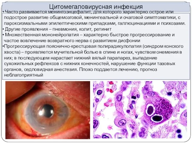 Цитомегаловирусная инфекция Часто развивается менингоэнцефалит, для которого характерно острое или