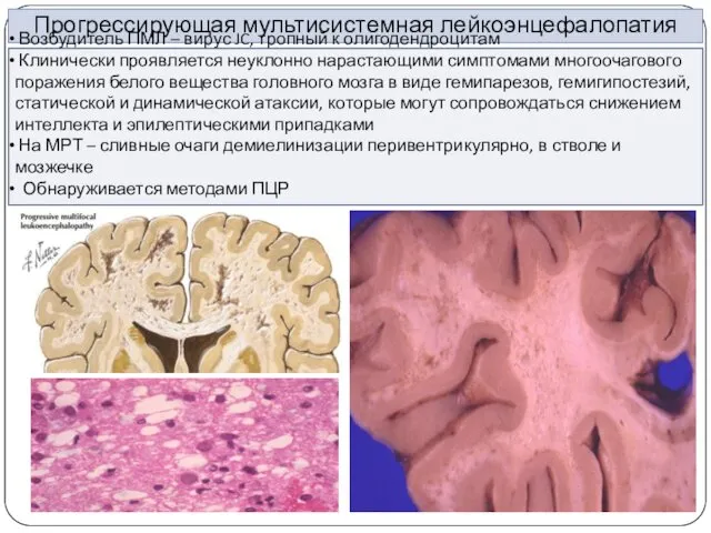 Прогрессирующая мультисистемная лейкоэнцефалопатия Возбудитель ПМЛ – вирус JC, тропный к