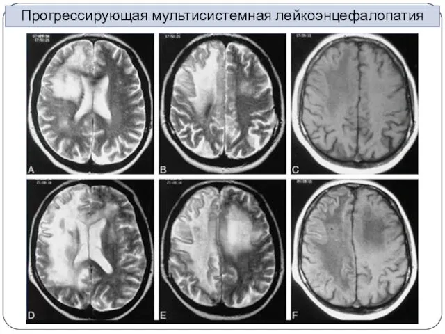 Прогрессирующая мультисистемная лейкоэнцефалопатия