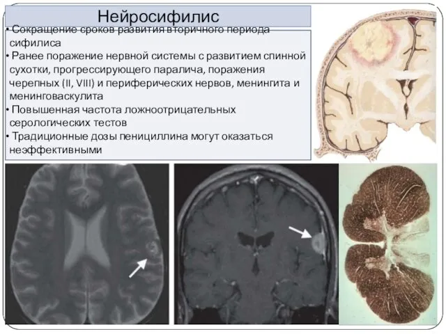 Нейросифилис Сокращение сроков развития вторичного периода сифилиса Ранее поражение нервной