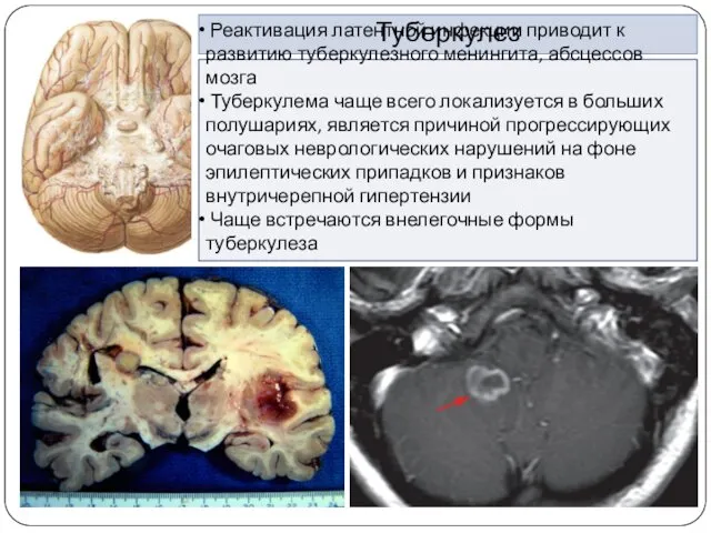 Туберкулез Реактивация латентной инфекции приводит к развитию туберкулезного менингита, абсцессов