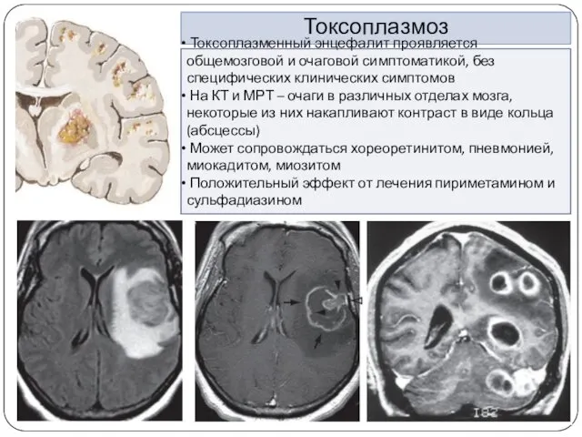 Токсоплазмоз Токсоплазменный энцефалит проявляется общемозговой и очаговой симптоматикой, без специфических