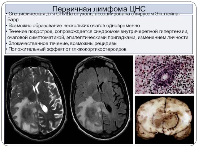 Первичная лимфома ЦНС Специфическая для СПИДа опухоль, ассоциирована с вирусом