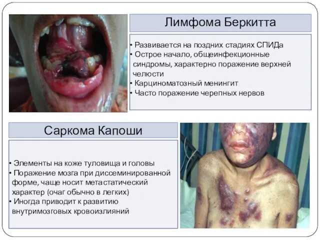 Лимфома Беркитта Развивается на поздних стадиях СПИДа Острое начало, общеинфекционные