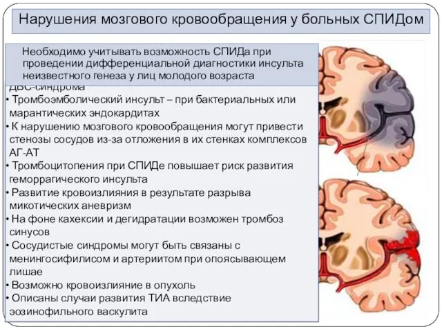 Нарушения мозгового кровообращения у больных СПИДом Инфаркты мозга могут быть