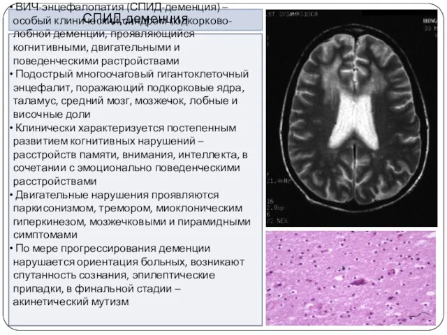 СПИД-деменция ВИЧ-энцефалопатия (СПИД-деменция) – особый клинический синдром подкорково-лобной деменции, проявляющийся