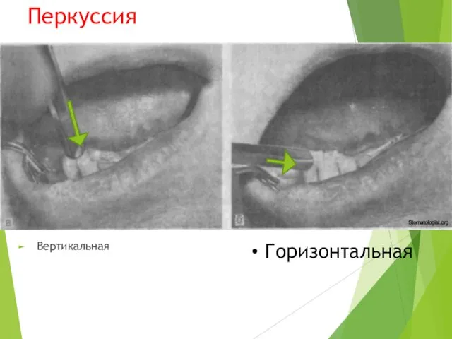 Перкуссия Вертикальная Горизонтальная