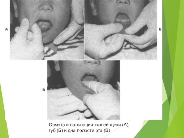 Осмотр и пальпация тканей щеки (А), губ (Б) и дна полости рта (В)