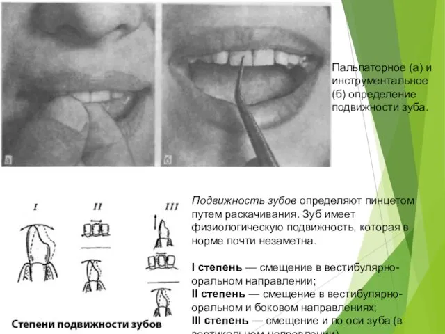 Пальпаторное (а) и инструментальное (б) определение подвижности зуба. Подвижность зубов