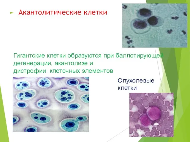 Акантолитические клетки Гигантские клетки образуются при баллотирующей дегенерации, акантолизе и дистрофии клеточных элементов Опухолевые клетки