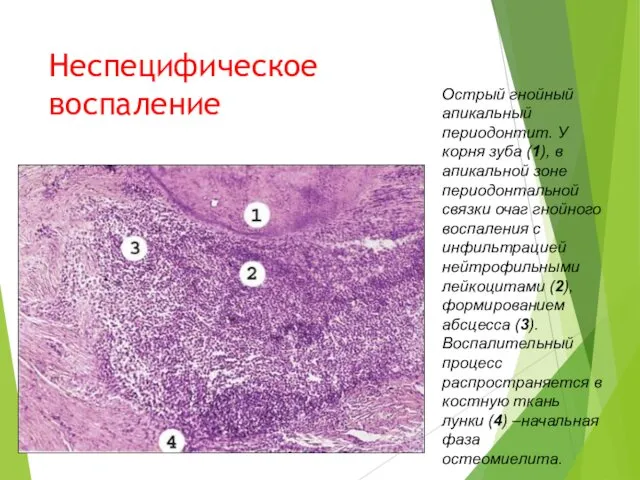 Неспецифическое воспаление Острый гнойный апикальный периодонтит. У корня зуба (1),