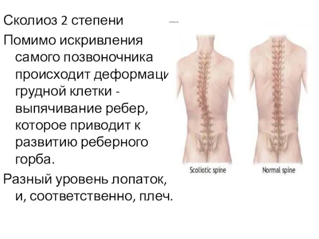 Сколиоз 2 степени Помимо искривления самого позвоночника происходит деформация грудной