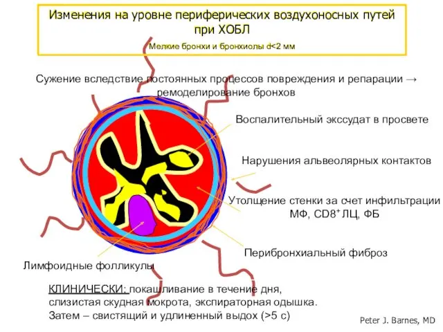 Нарушения альвеолярных контактов Воспалительный экссудат в просвете Перибронхиальный фиброз Лимфоидные