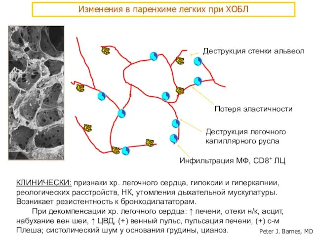 Деструкция стенки альвеол Потеря эластичности Деструкция легочного капиллярного русла Инфильтрация