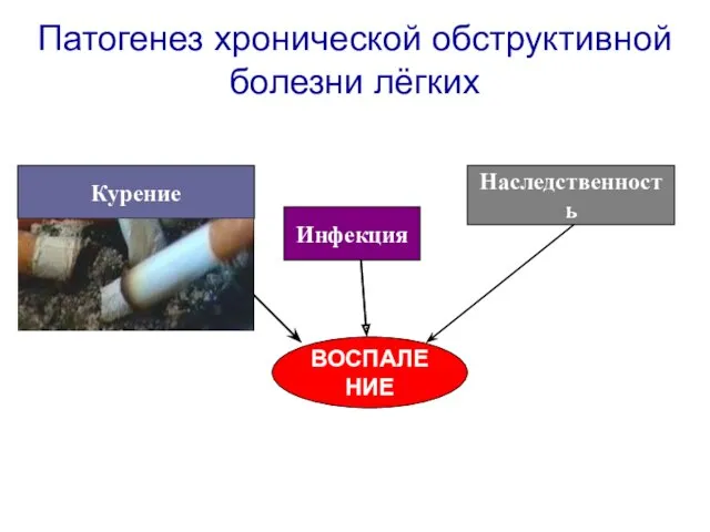 Патогенез хронической обструктивной болезни лёгких Курение Инфекция Наследственность ВОСПАЛЕНИЕ