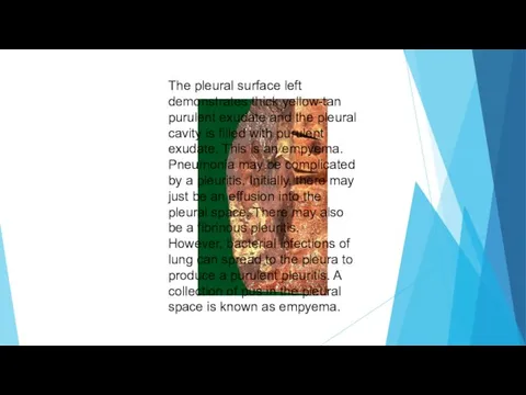 The pleural surface left demonstrates thick yellow-tan purulent exudate and