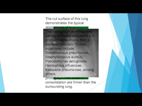 The cut surface of this lung demonstrates the typical appearance