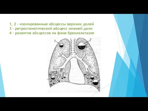 1, 2 – изолированные абсцессы верхних долей 3 – ретростенотический