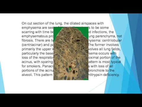 On cut section of the lung, the dilated airspaces with