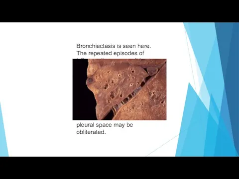 Bronchiectasis is seen here. The repeated episodes of inflammation can