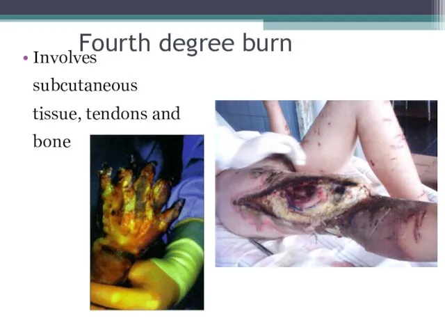 Fourth degree burn Involves subcutaneous tissue, tendons and bone