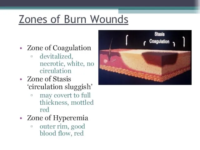 Zones of Burn Wounds Zone of Coagulation devitalized, necrotic, white,