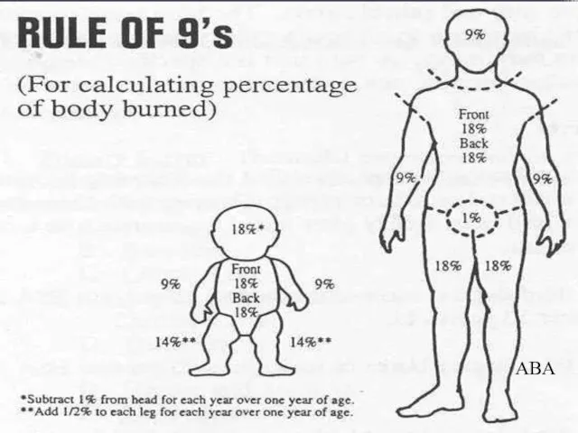 Rule of 9s ABA