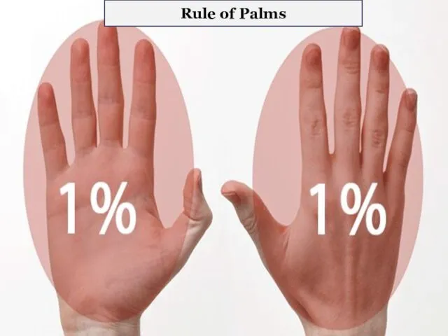 Rule of Palms