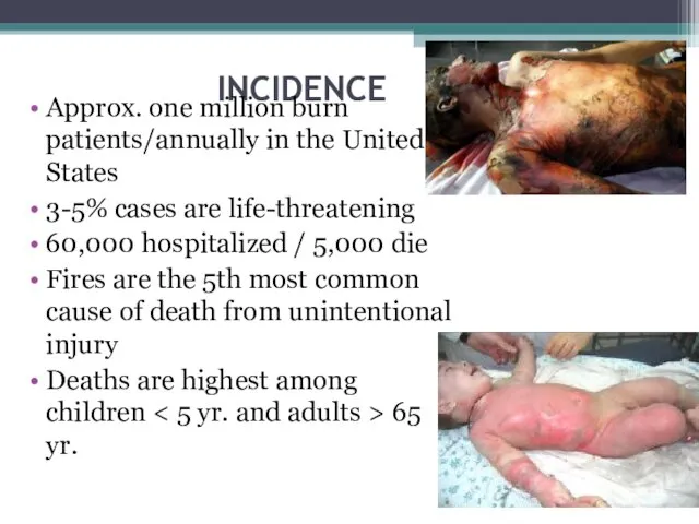 INCIDENCE Approx. one million burn patients/annually in the United States