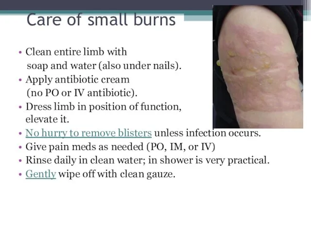 Care of small burns Clean entire limb with soap and