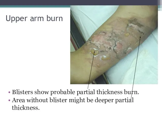 Upper arm burn Blisters show probable partial thickness burn. Area