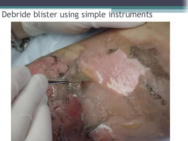 Debride blister using simple instruments