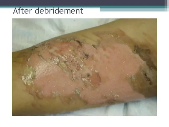 After debridement