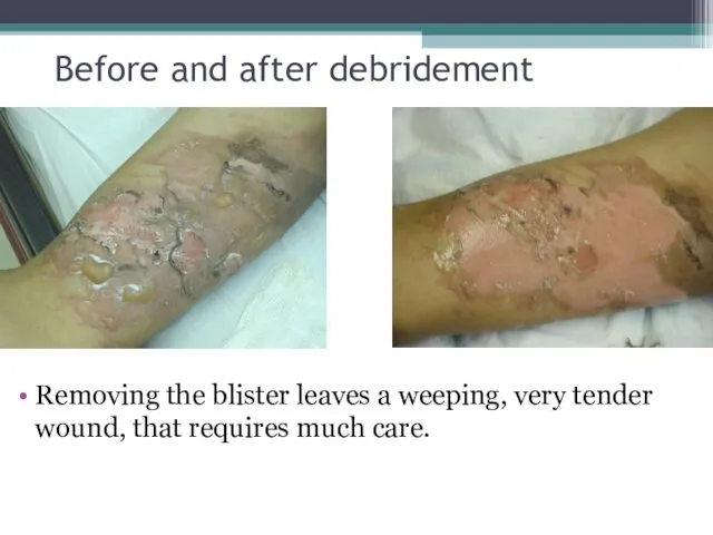 Before and after debridement Removing the blister leaves a weeping,