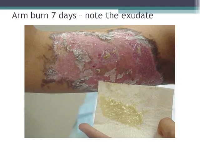 Arm burn 7 days – note the exudate