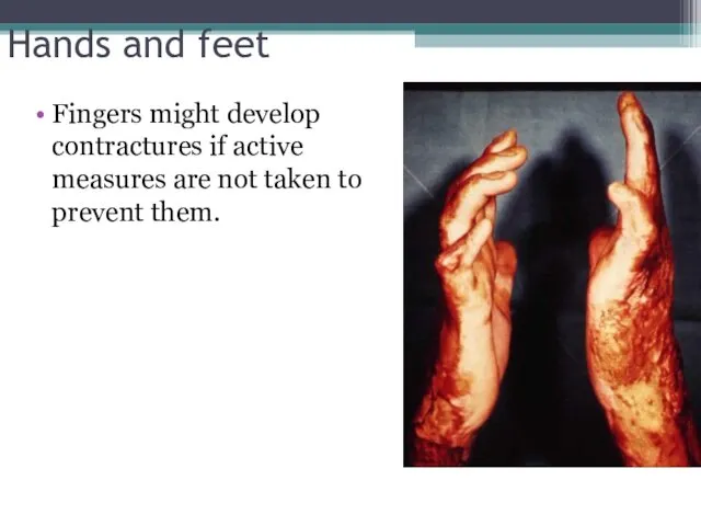 Hands and feet Fingers might develop contractures if active measures are not taken to prevent them.