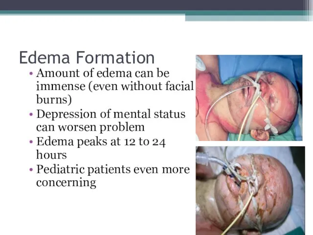 Edema Formation Amount of edema can be immense (even without
